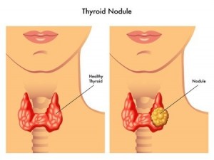 thyroid_cancer